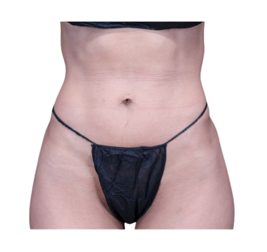 rib remodeling before