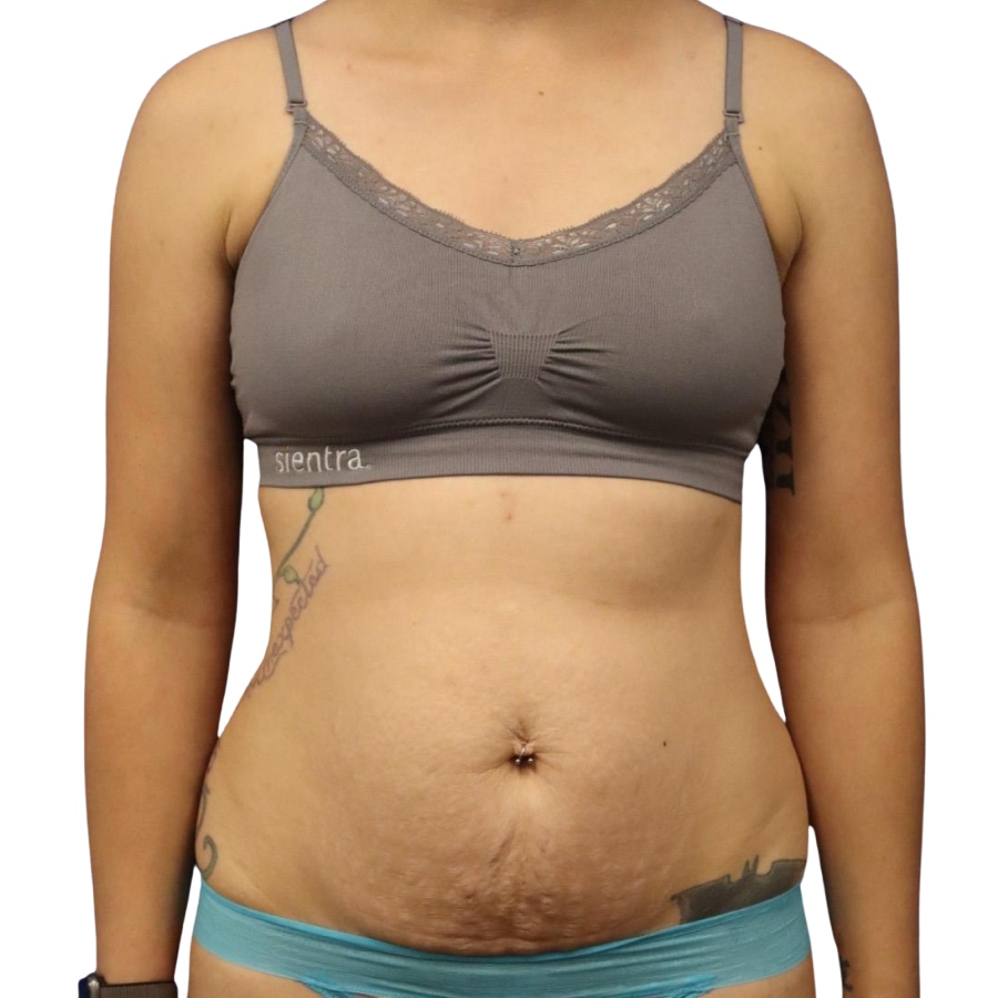 tummy tuck before