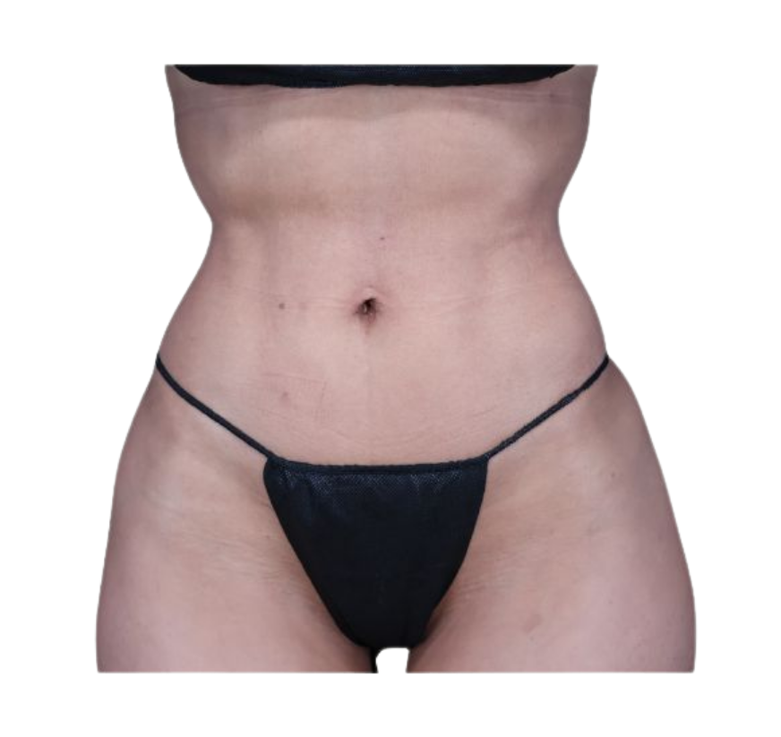 rib remodeling after