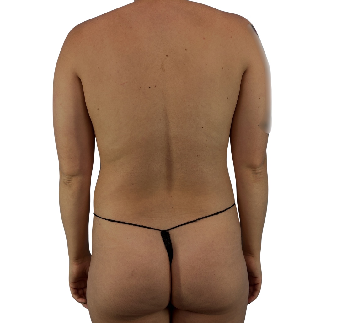 liposuction before