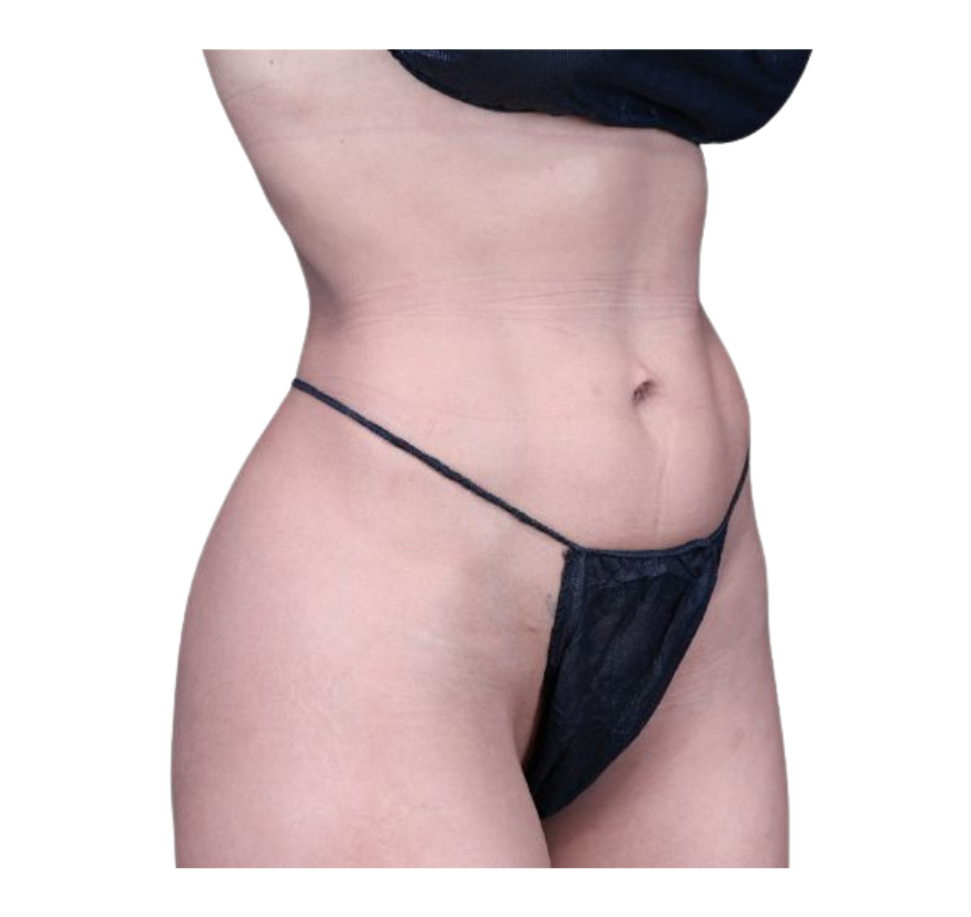 rib remodeling before