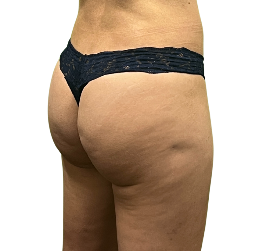 cellulite before