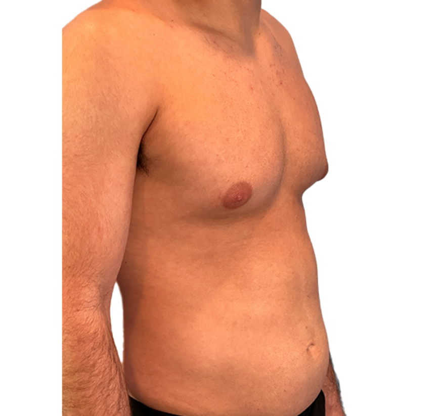 smart core contour before