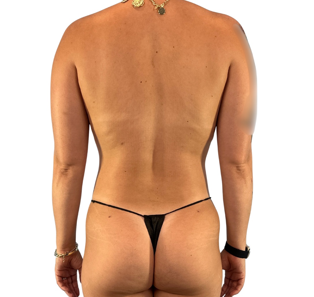 liposuction after