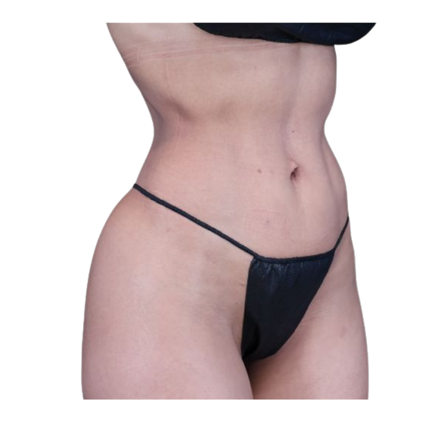 rib remodeling after