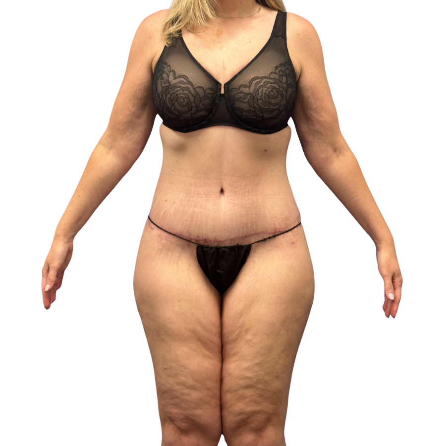 tummy tuck after