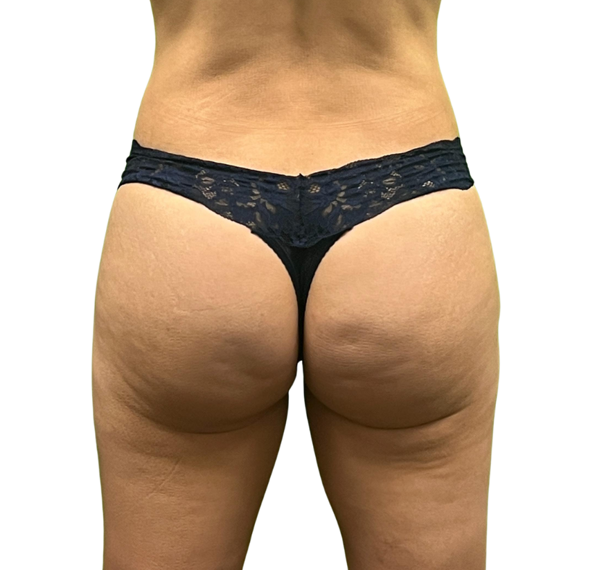 cellulite before