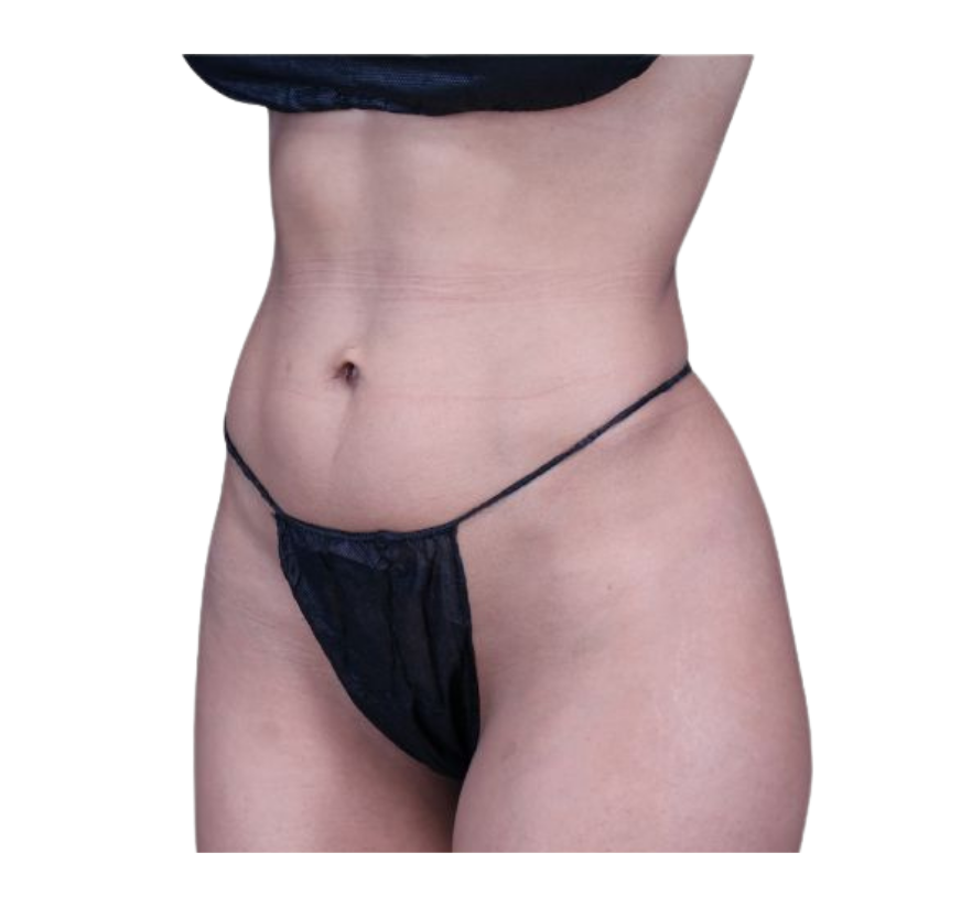 rib remodeling before
