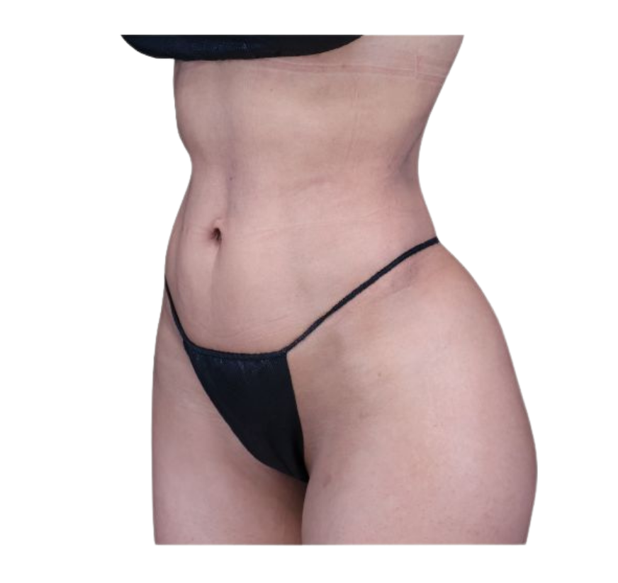 rib remodeling after