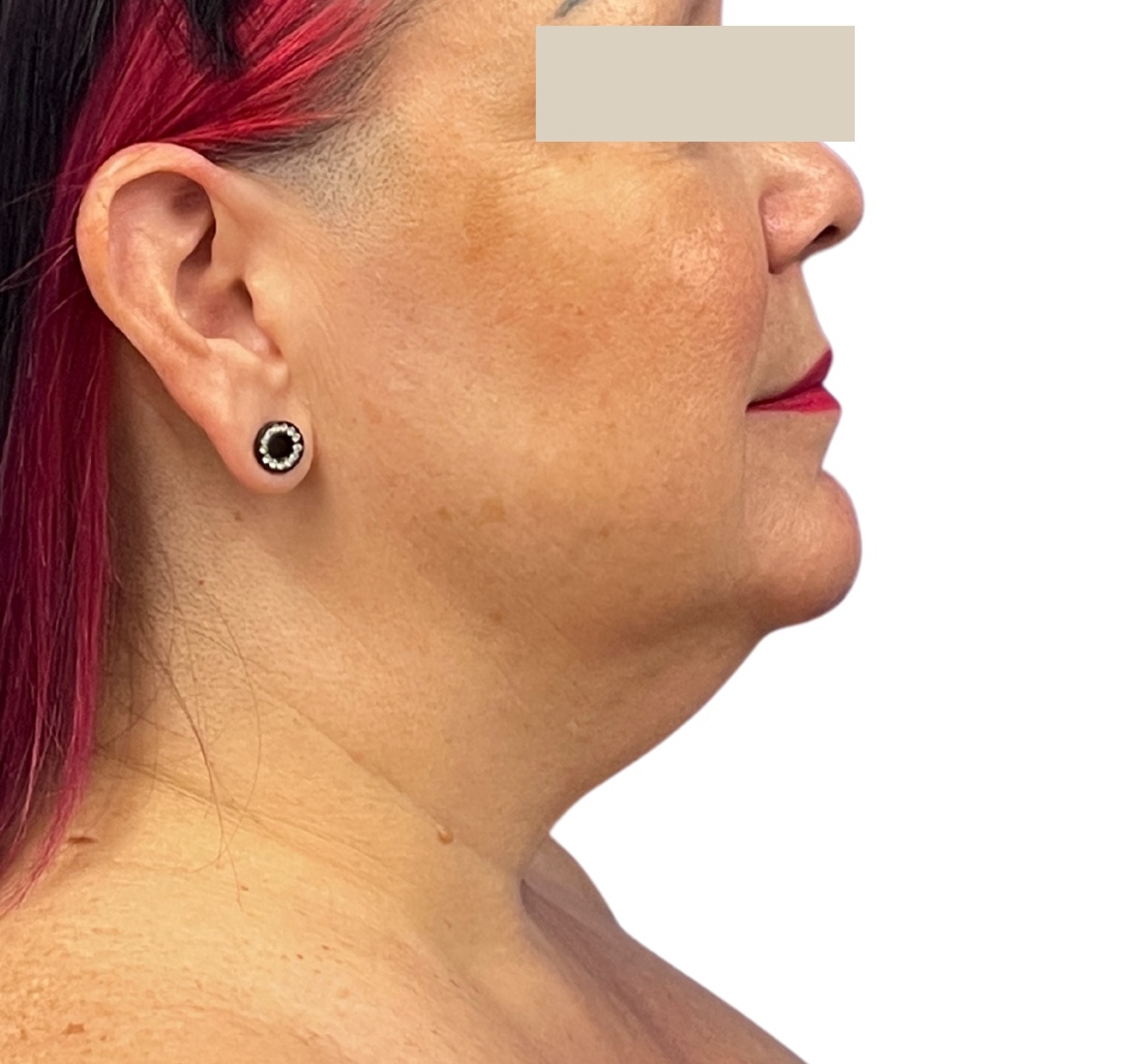 chin liposuction before