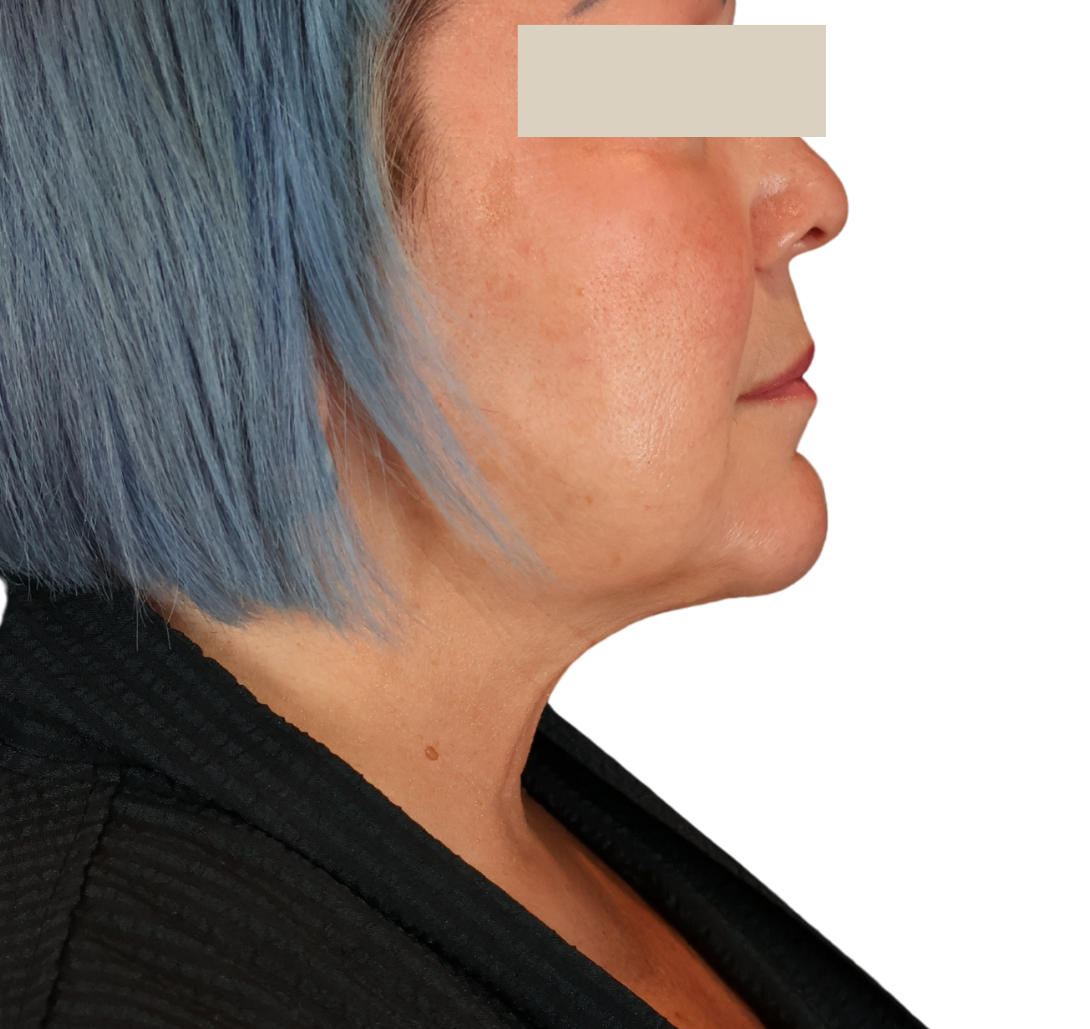 chin liposuction after