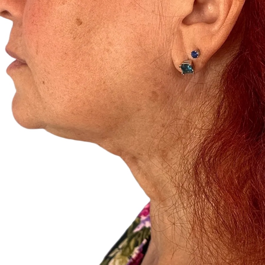 overnight lift after