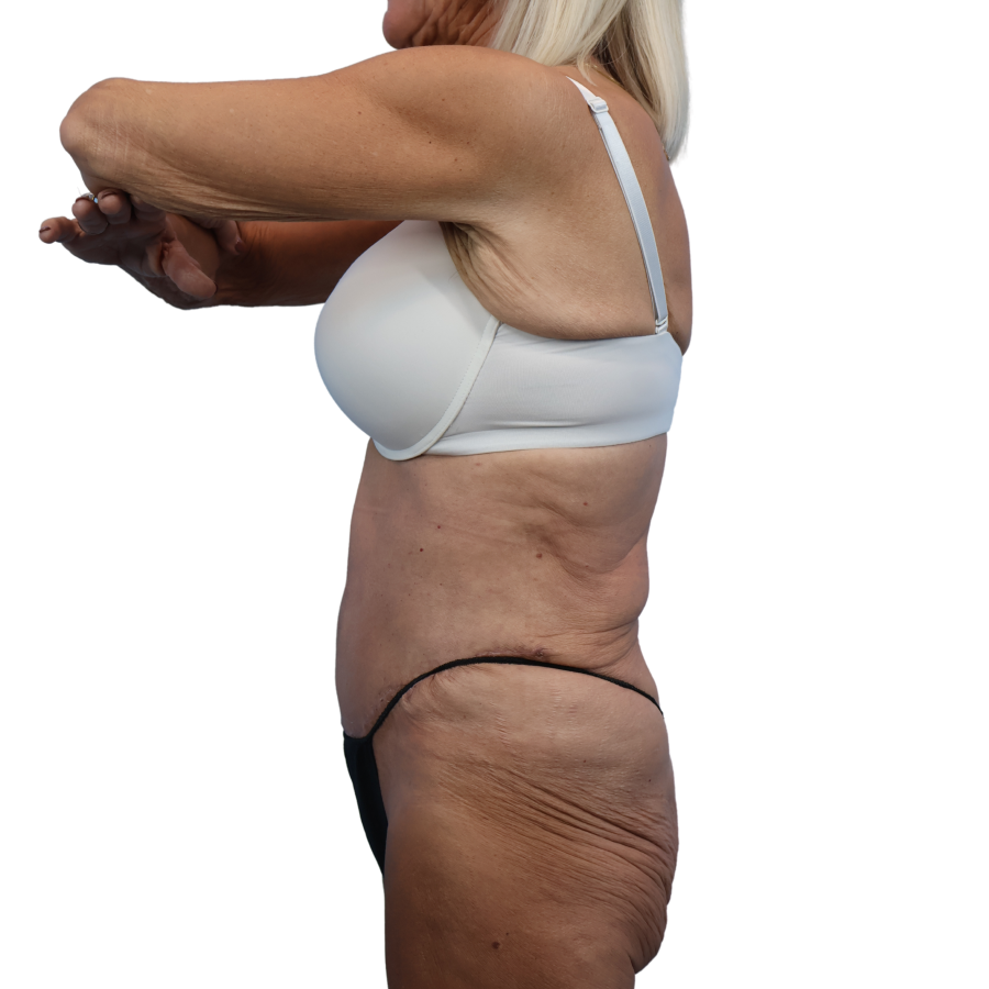 tummy tuck after