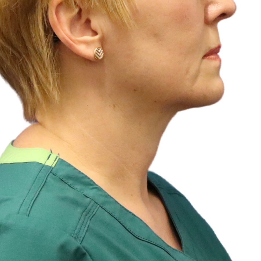 neck lift after