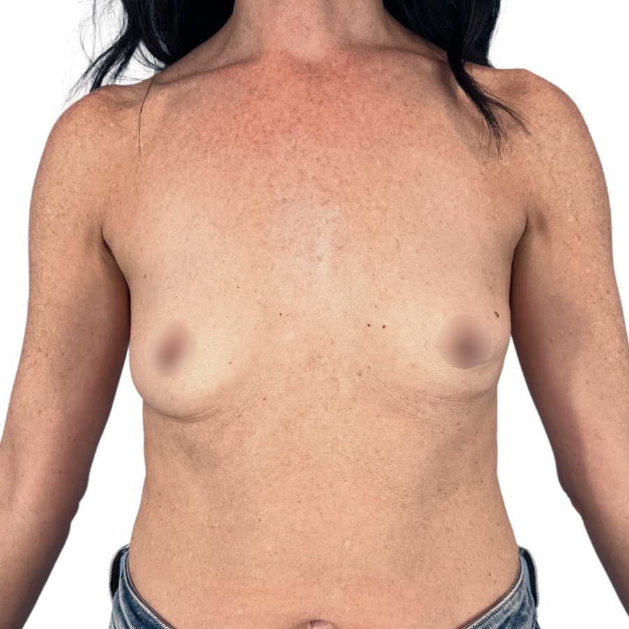 breast aug before
