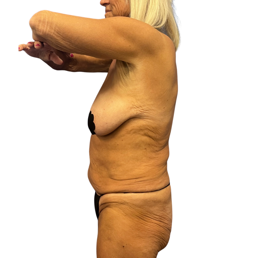 tummy tuck before