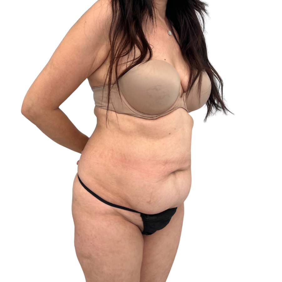 tummy tuck before