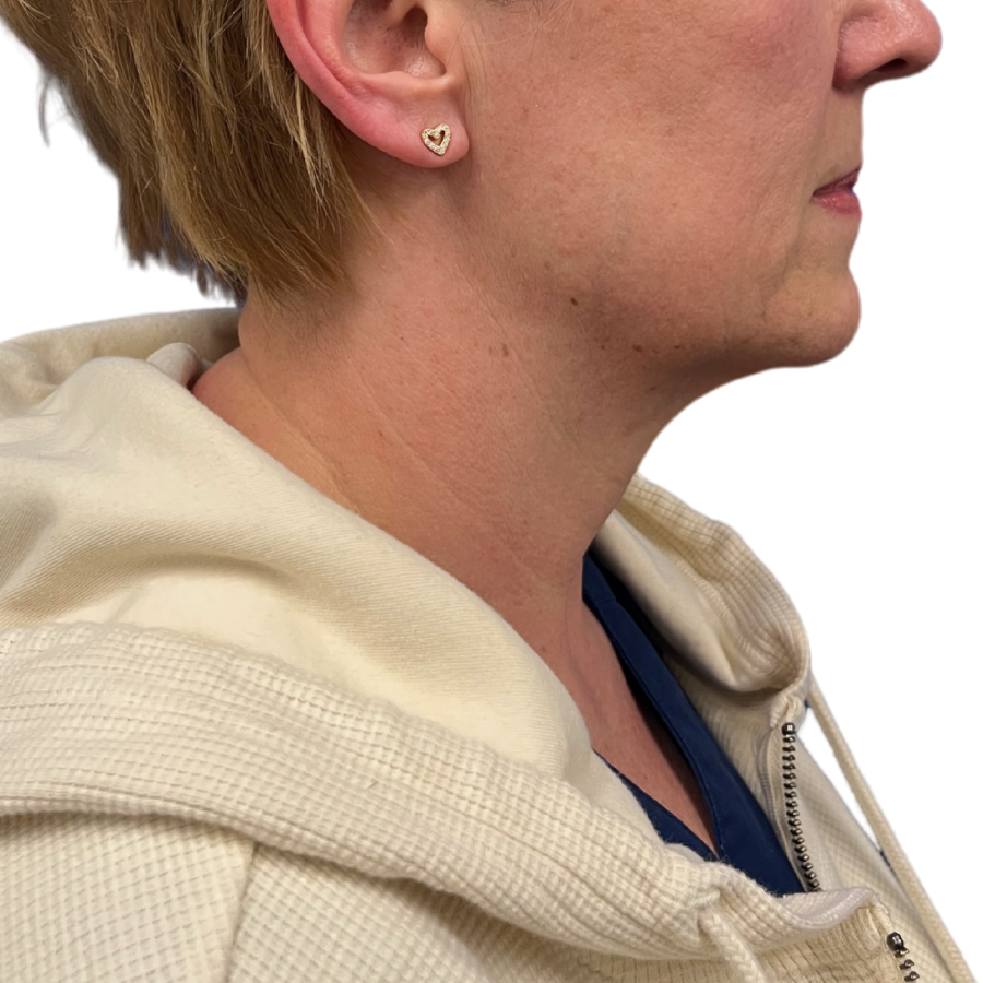 neck lift before