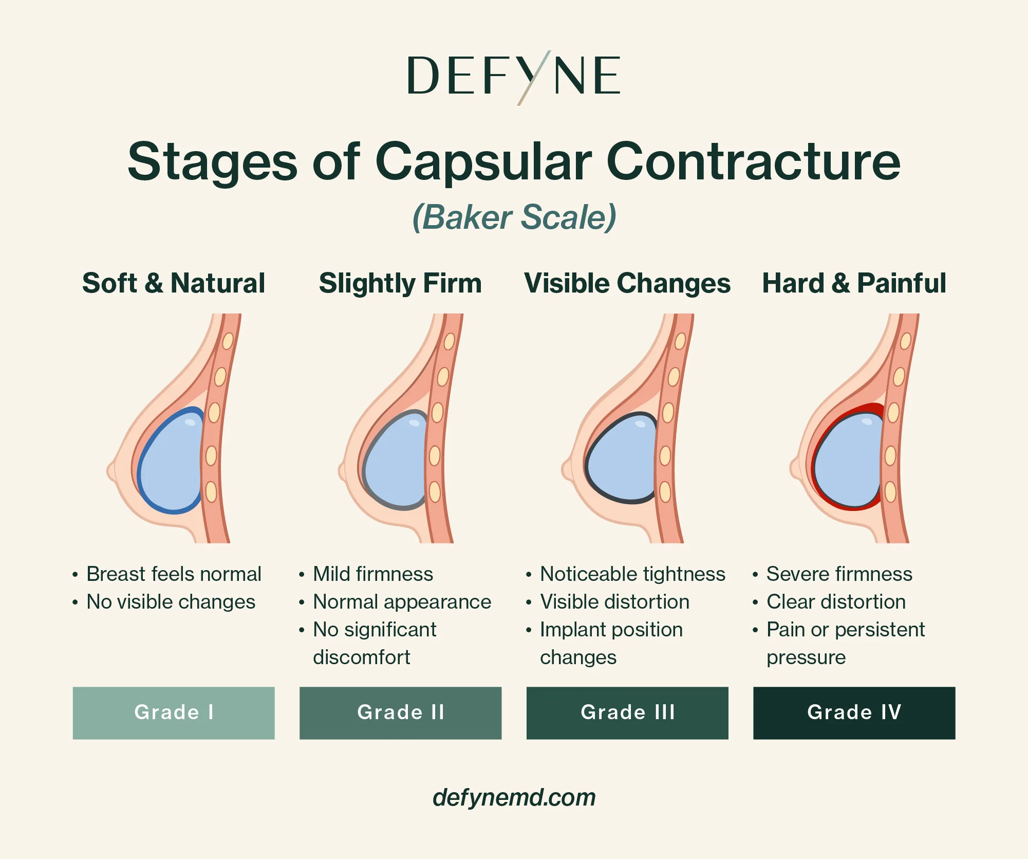 baker scale stages of capsular contracture