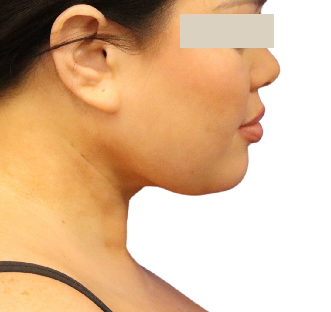 chin liposuction after