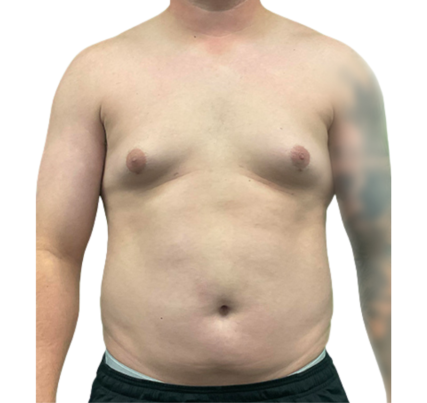 smart core contour before