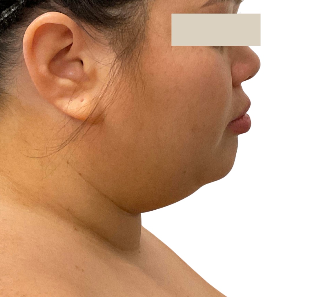 chin liposuction before