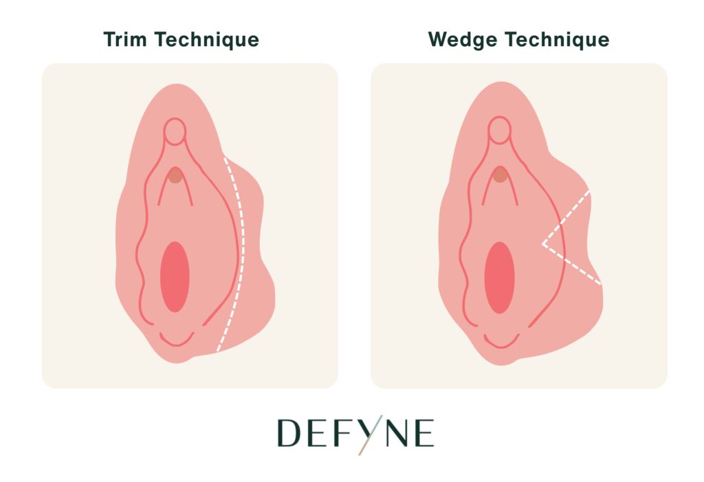 labiaplasty techniques
