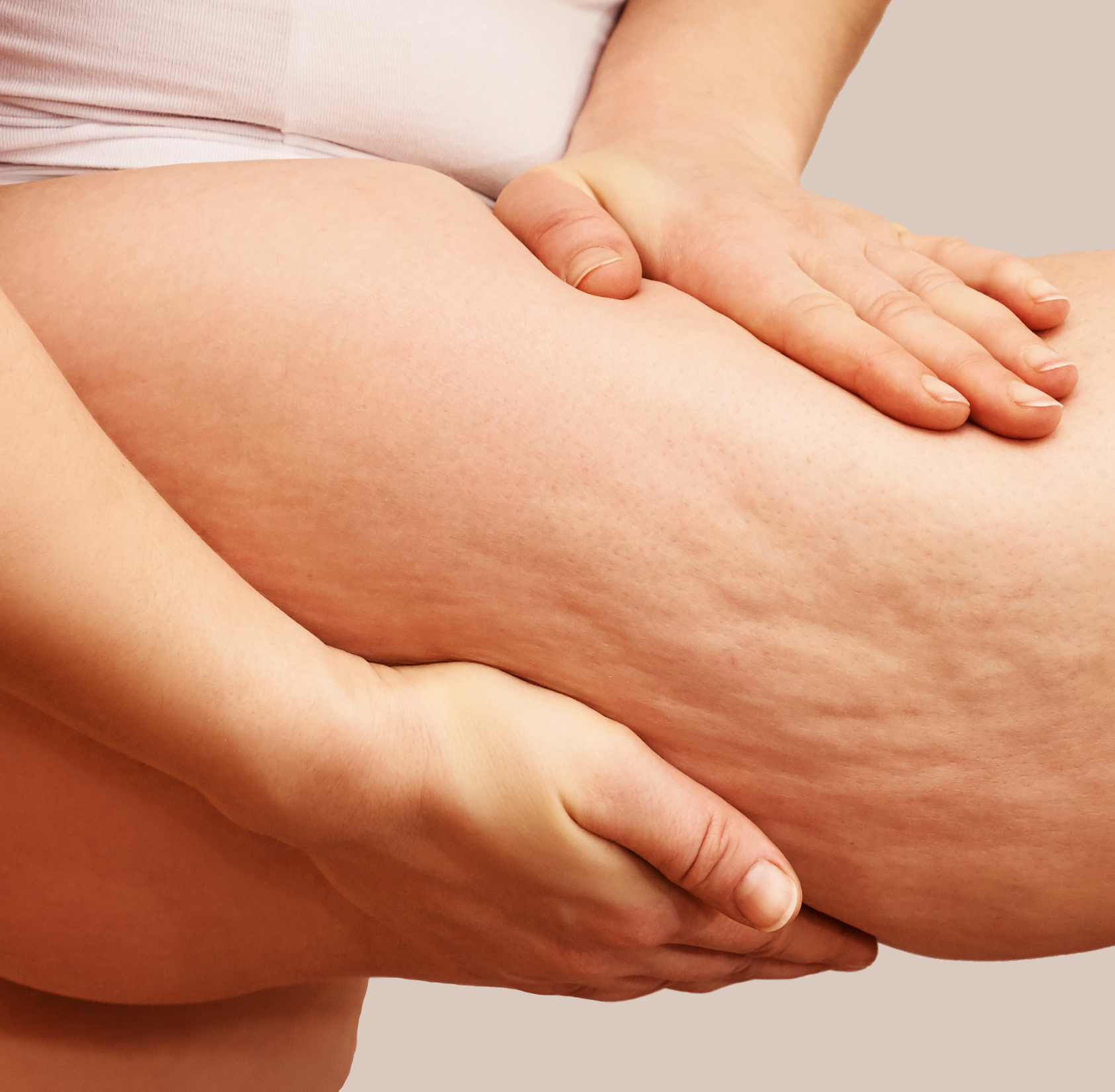 What Causes Cellulite? Understanding the Science and Solutions