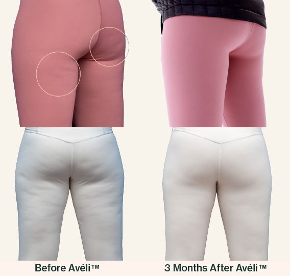before and after Aveli treatment