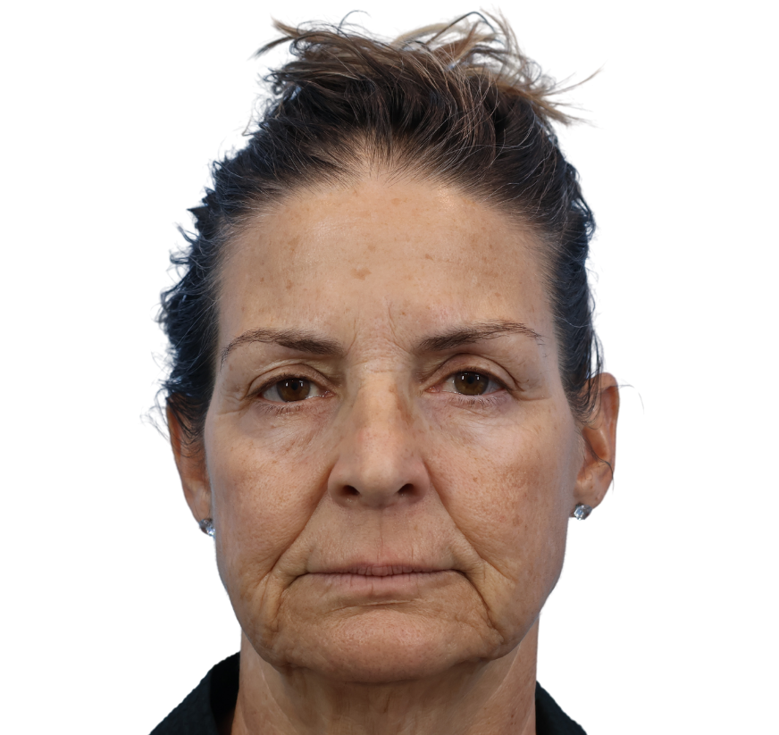 facelift before
