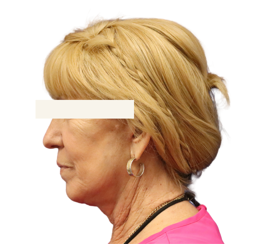 facelift after