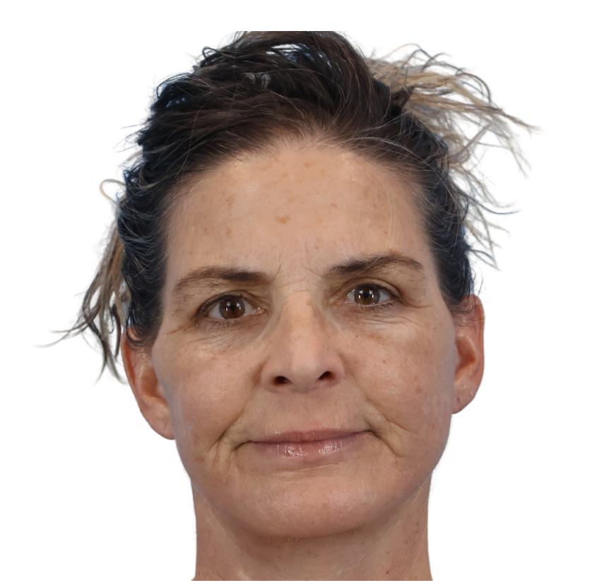 facelift after