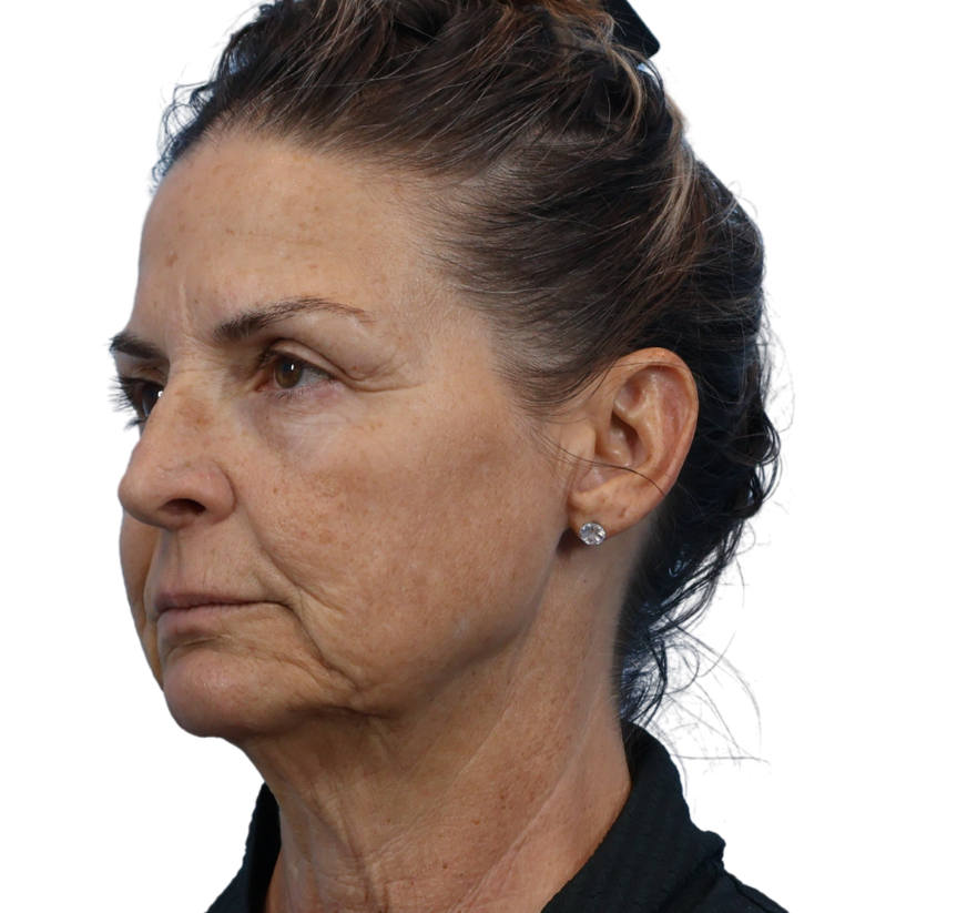 facelift before