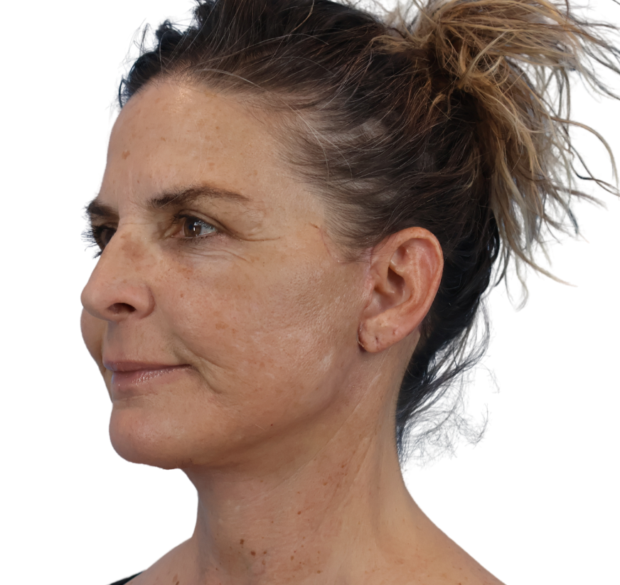 facelift after