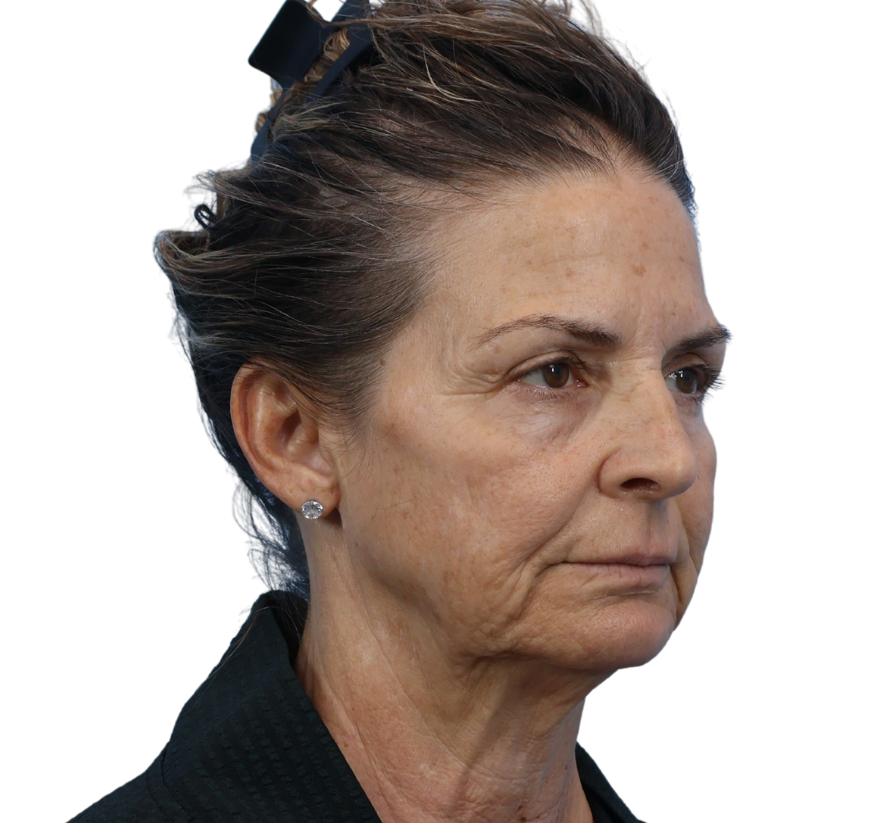 facelift before