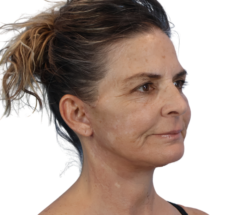 facelift after