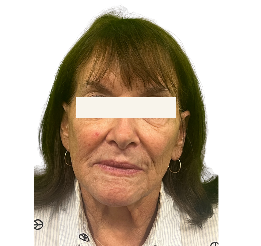 facelift before