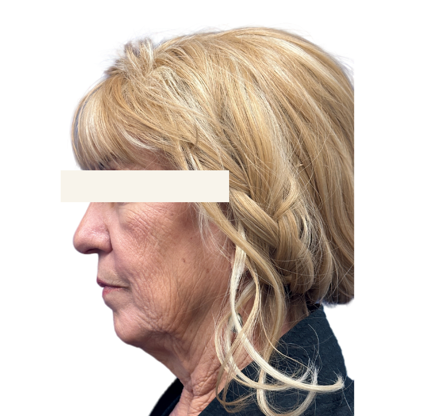 facelift before