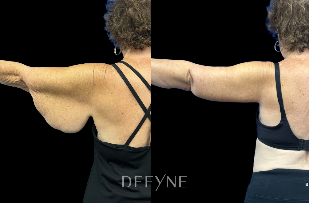 Before and after — Arm Lift, Patient #2185, view 2