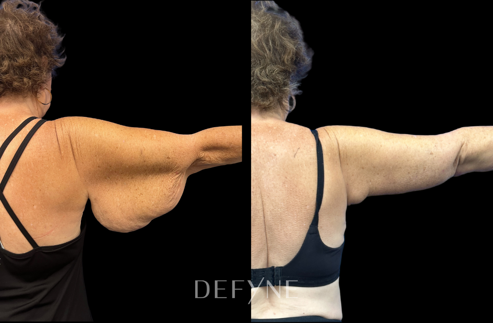 Before and after — Arm Lift, Patient #2185