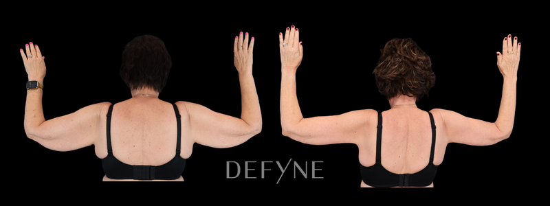 Before and after — Arm Lift, Patient #2508