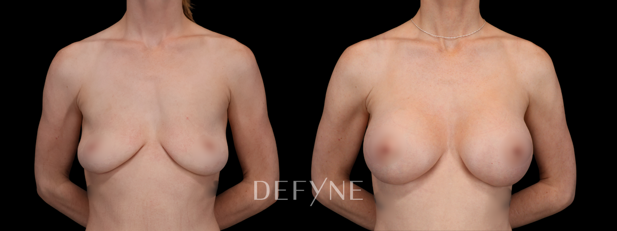 Before and after — Breast Augmentation with Implants, Patient #5264