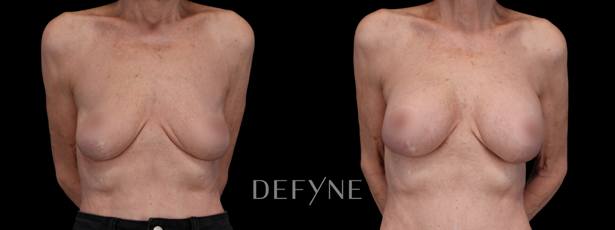 Before and after — Breast Augmentation with Implants, Patient #5495