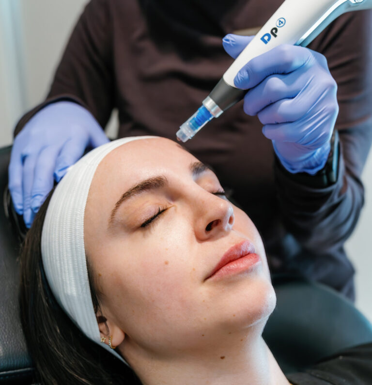 microneedling