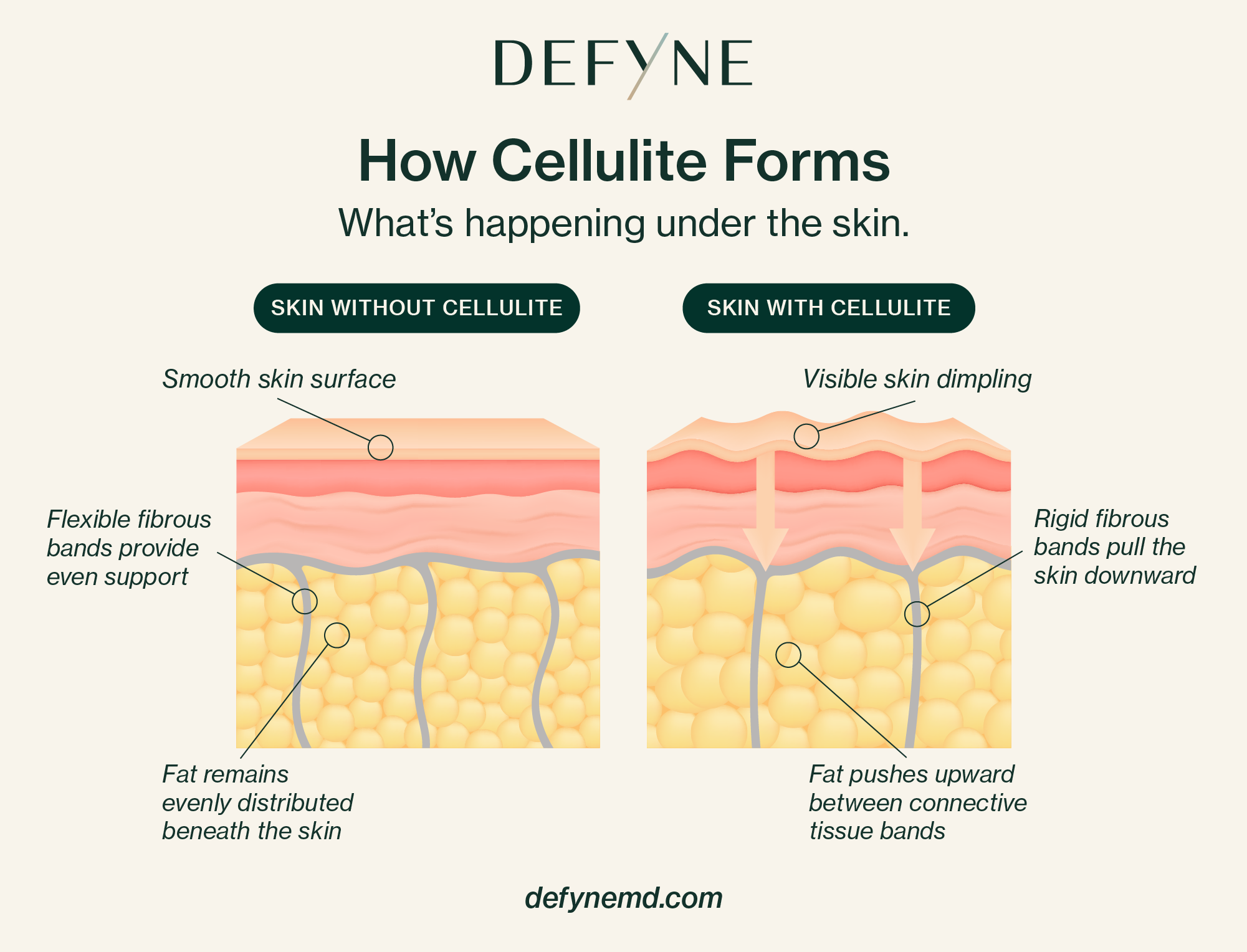 How Cellulite Forms