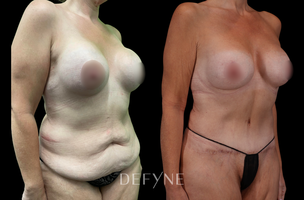 Before and after — Mommy Makeover, Patient #114, view 2
