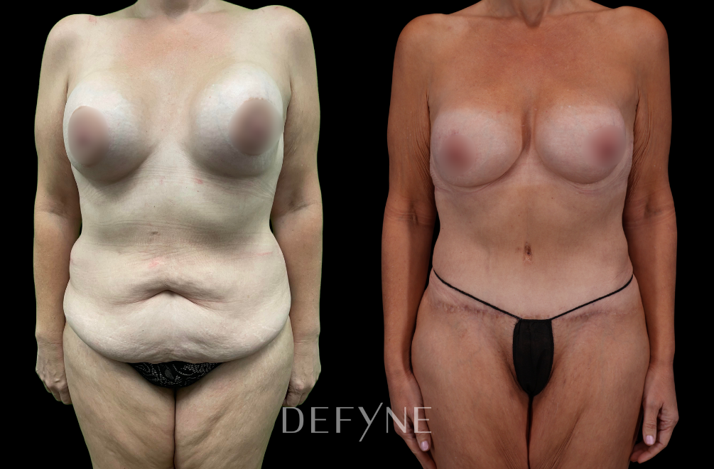 Before and after — Mommy Makeover, Patient #114