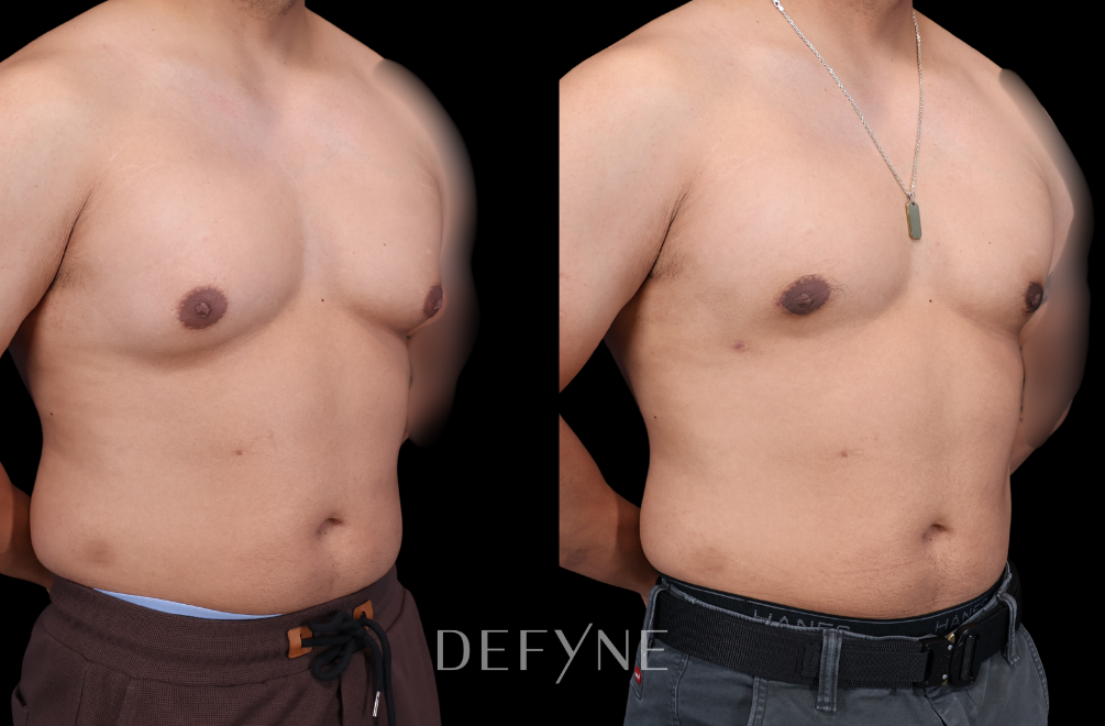 Before and after — Gynecomastia Reduction, Patient #3475, view 2