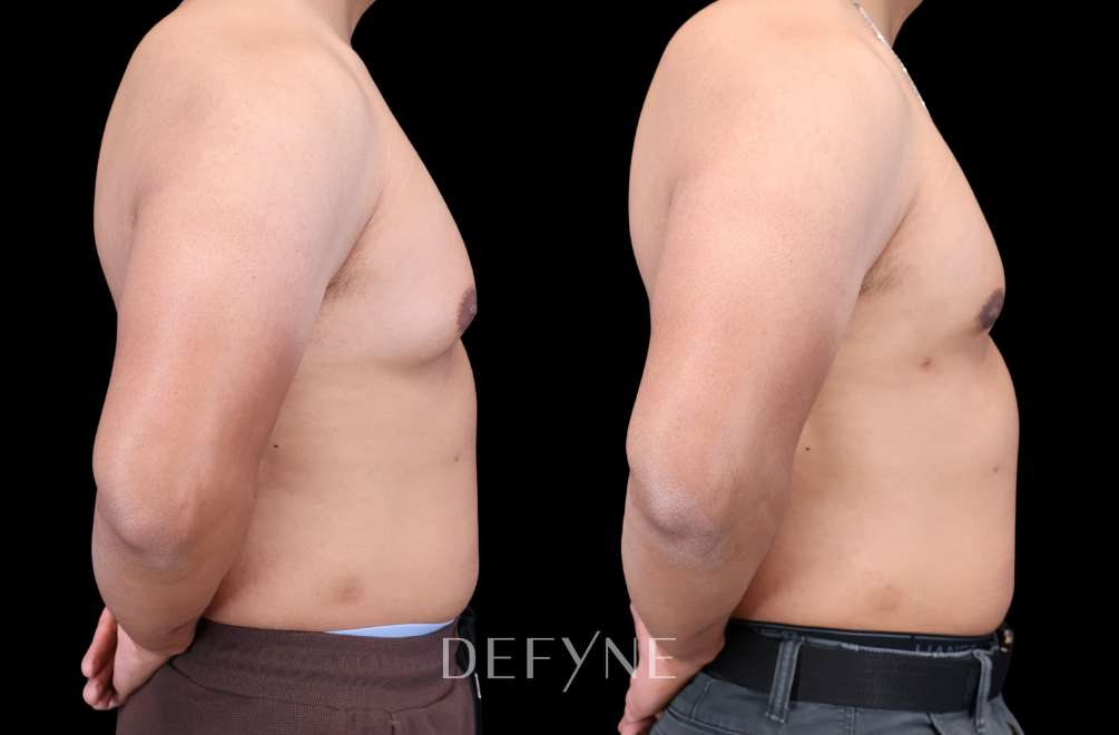 Before and after — Gynecomastia Reduction, Patient #3475, view 3