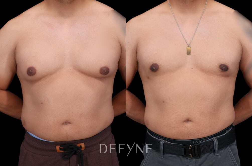Before and after — Gynecomastia Reduction, Patient #3475